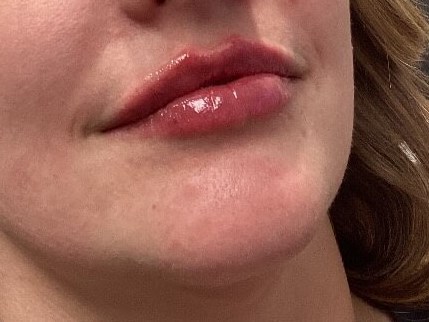 Juvederm Lip Enhancement After