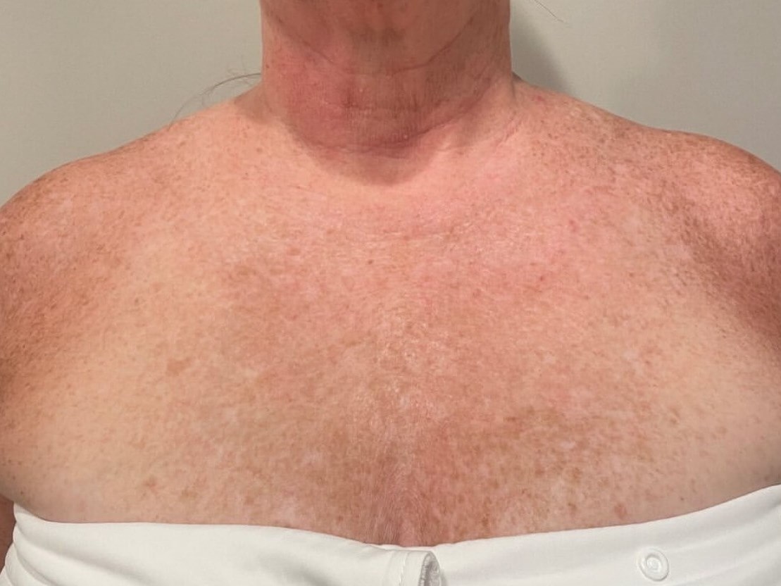 Rejuvenating Your Chest After
