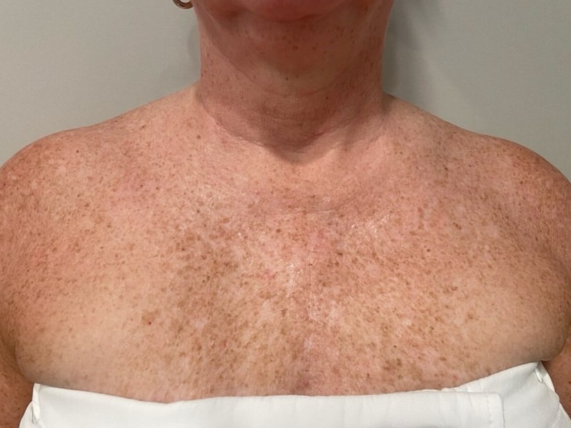 Rejuvenating Your Chest Before