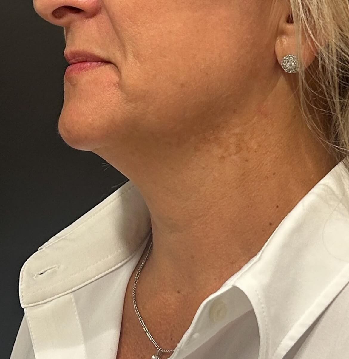 Transform Your Chin After