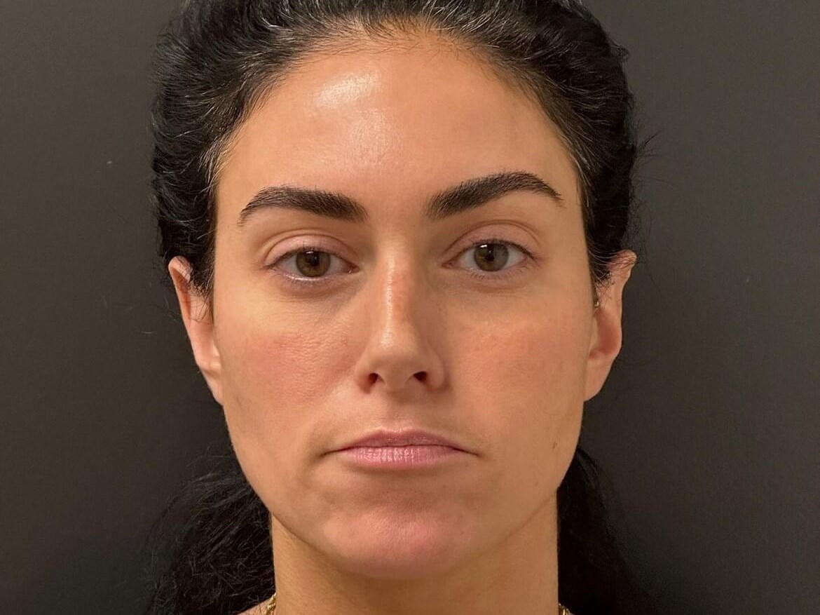The Magic of Botox After