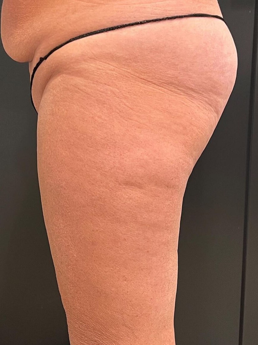 Emsculpt Neo: Sculpt and Lift Before