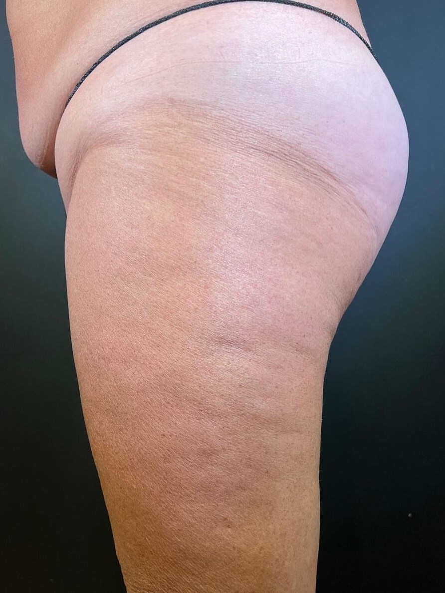 Emsculpt Neo: Sculpt and Lift After