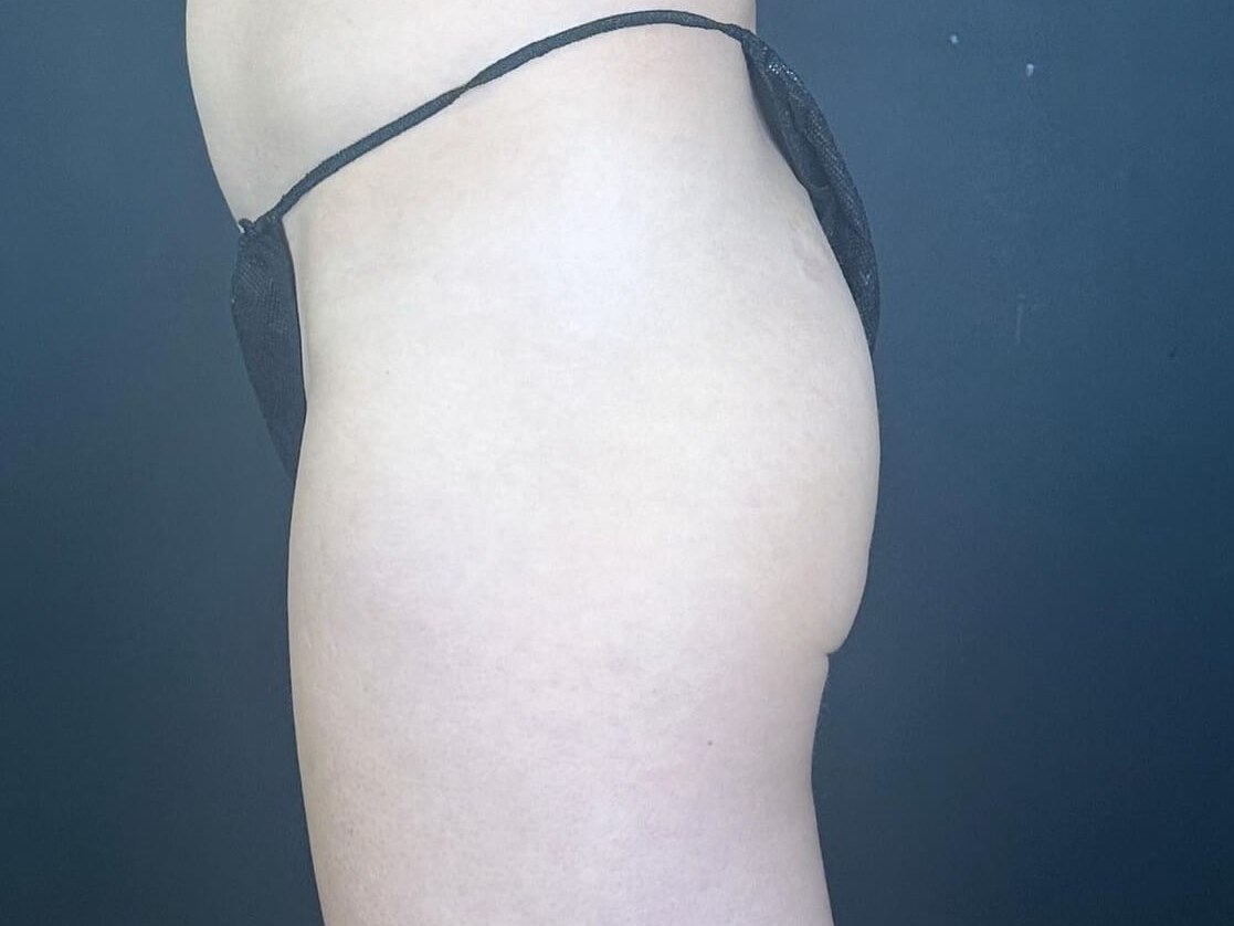 Emsculpt Neo: Define and Tone Before