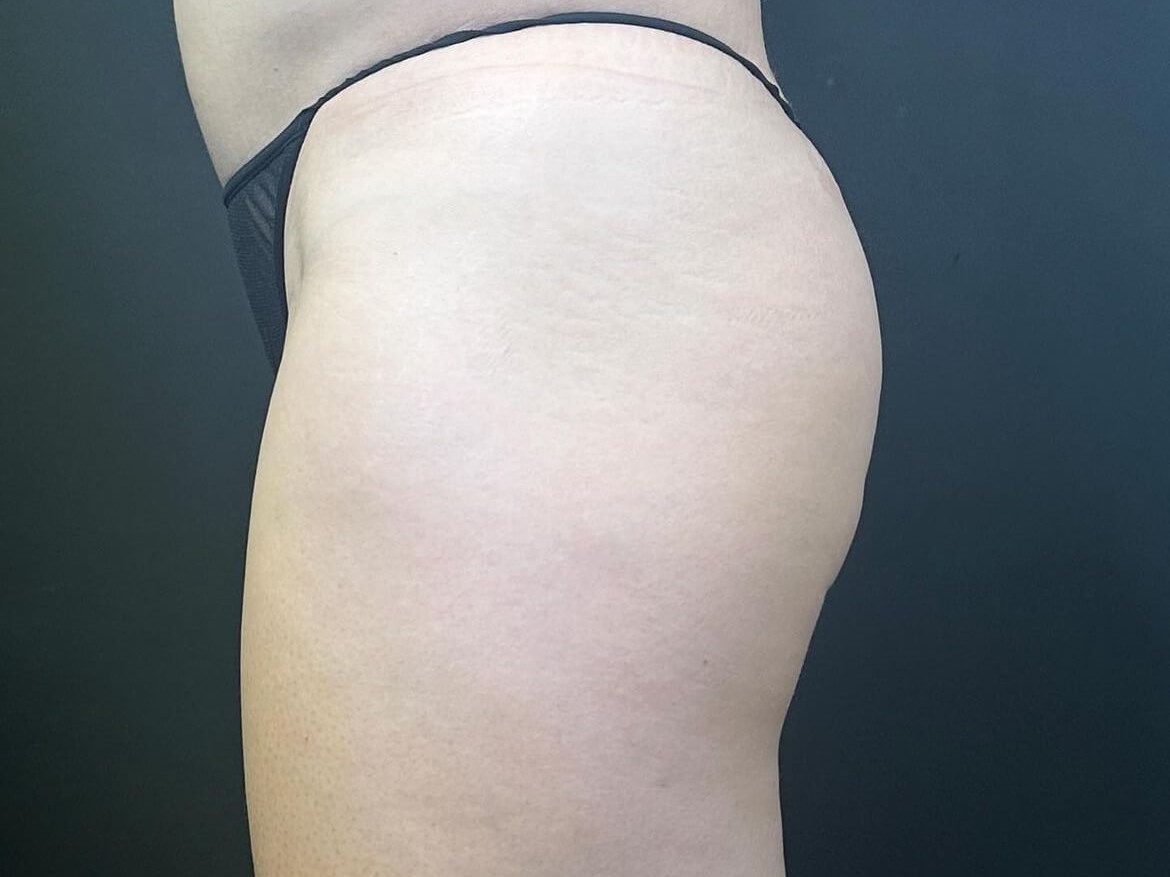 Emsculpt Neo: Define and Tone After