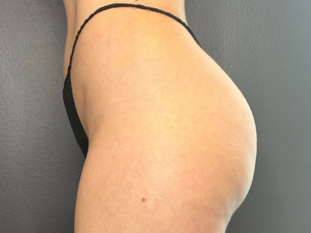 Sculpt Your Buttocks Before