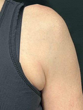 Contour Armpit Fat Before