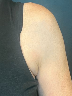 Contour Armpit Fat After