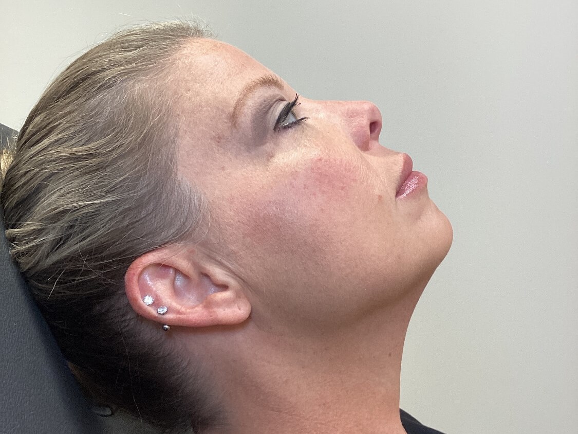 Enhance Your Jawline Before