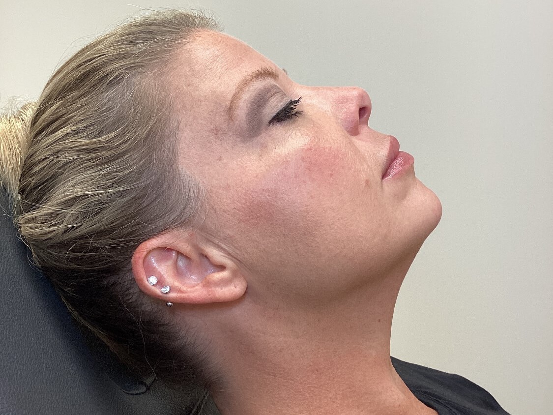 Enhance Your Jawline After