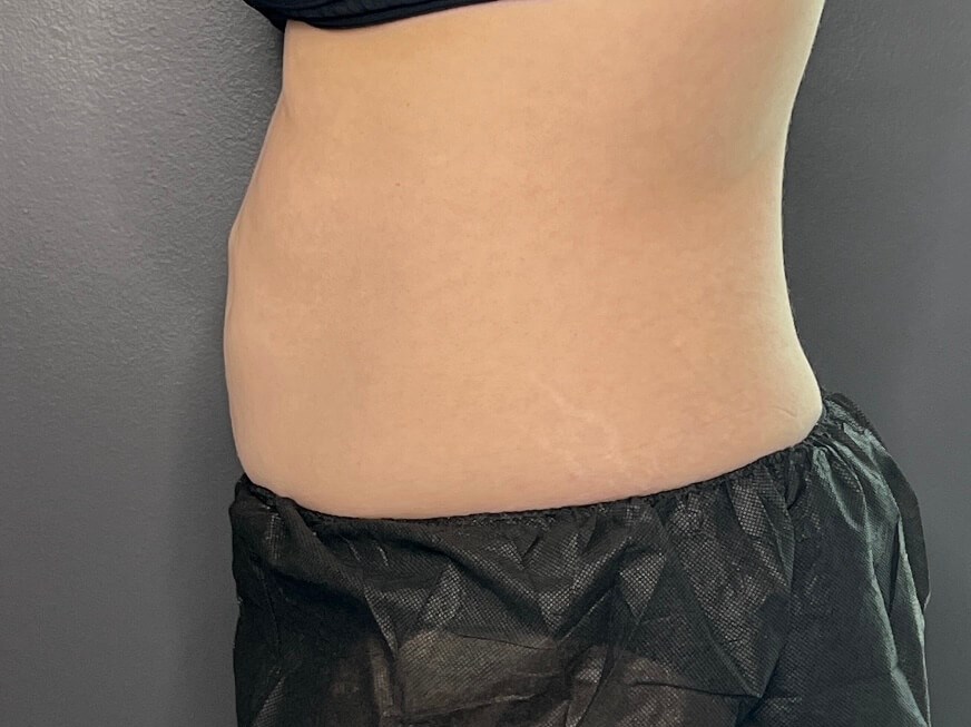 Contoured Abdomen After
