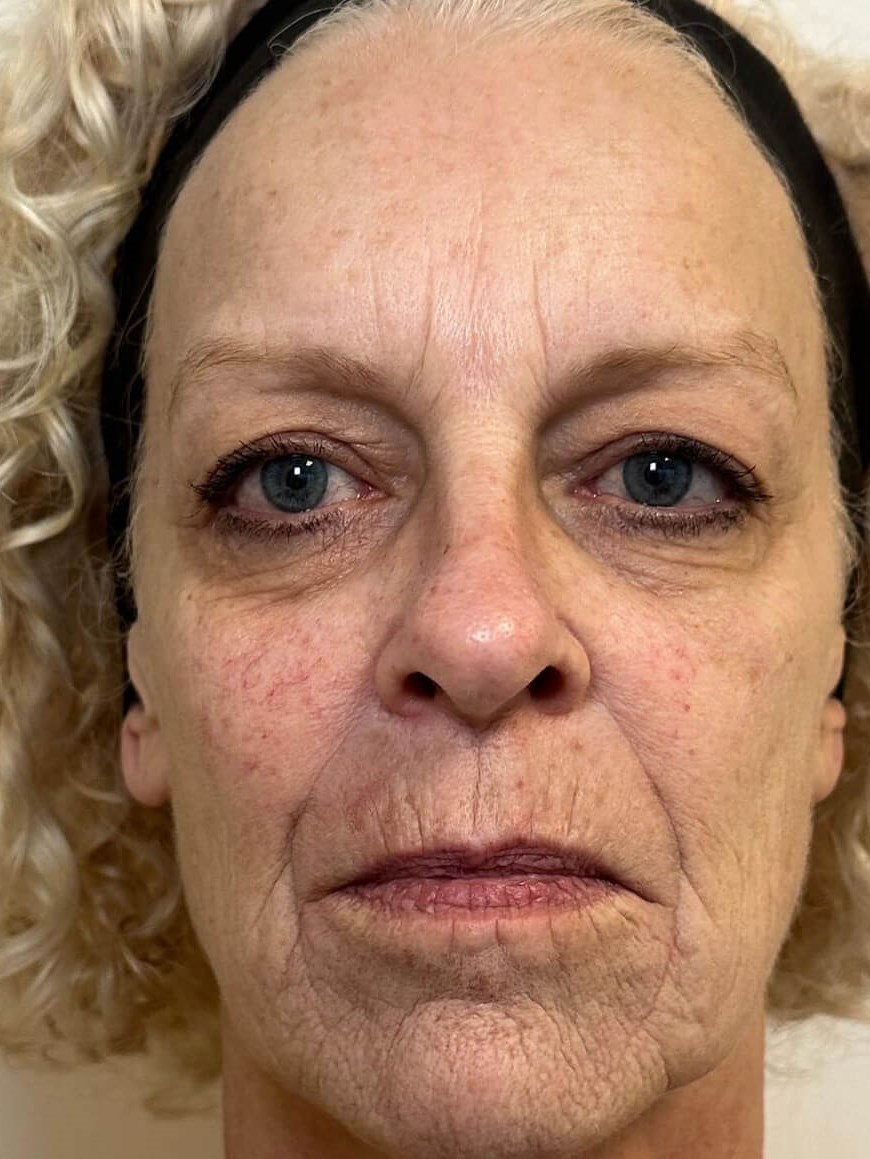 Radiant Skin Before