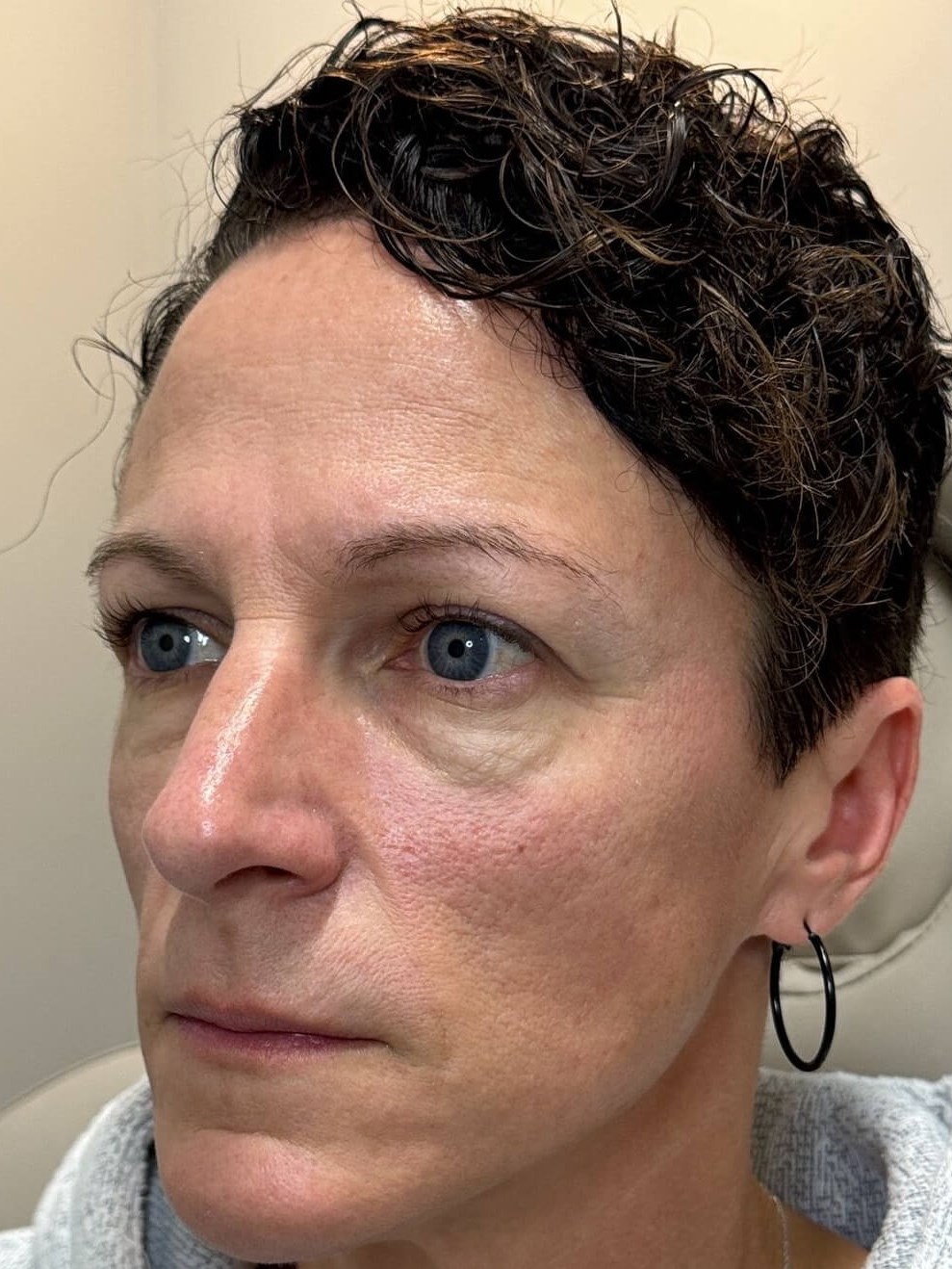 Achieving a youthful glow Before