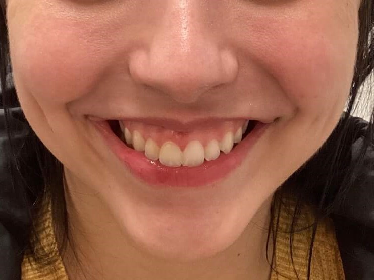 Gummy Smile fixed with Botox Before