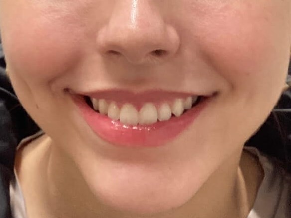 Gummy Smile fixed with Botox After
