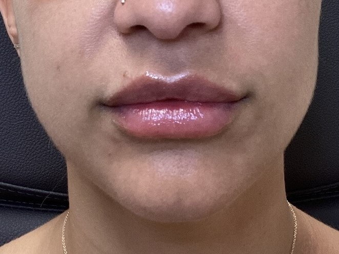 Juvederm Ultra Lips After