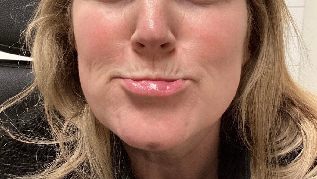 Chin Botox After