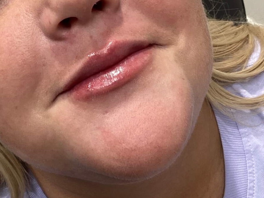 Lip Filler After