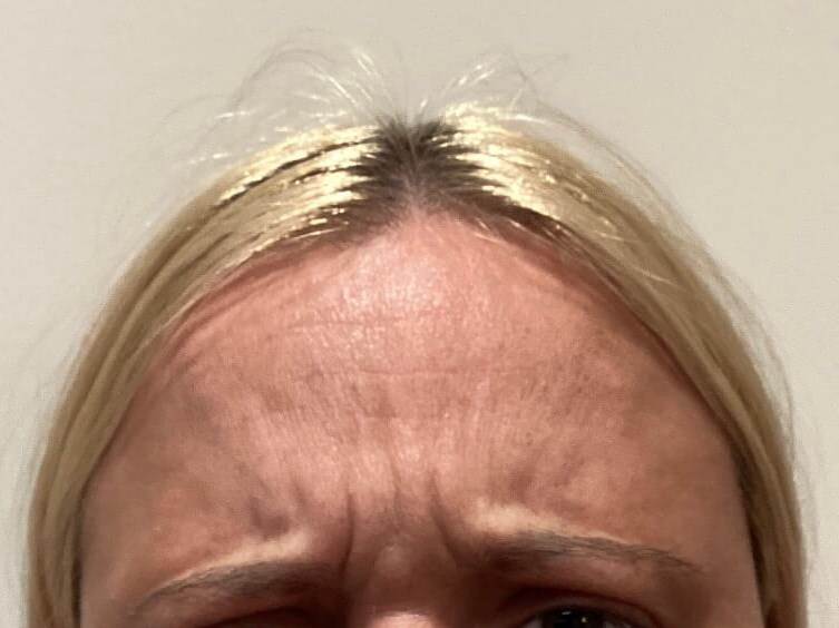 Forehead Botox Before