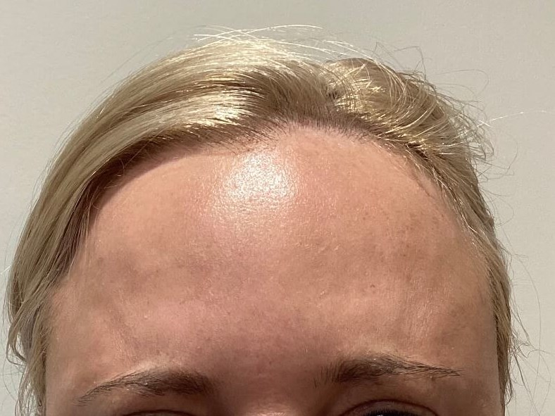 Forehead Botox After