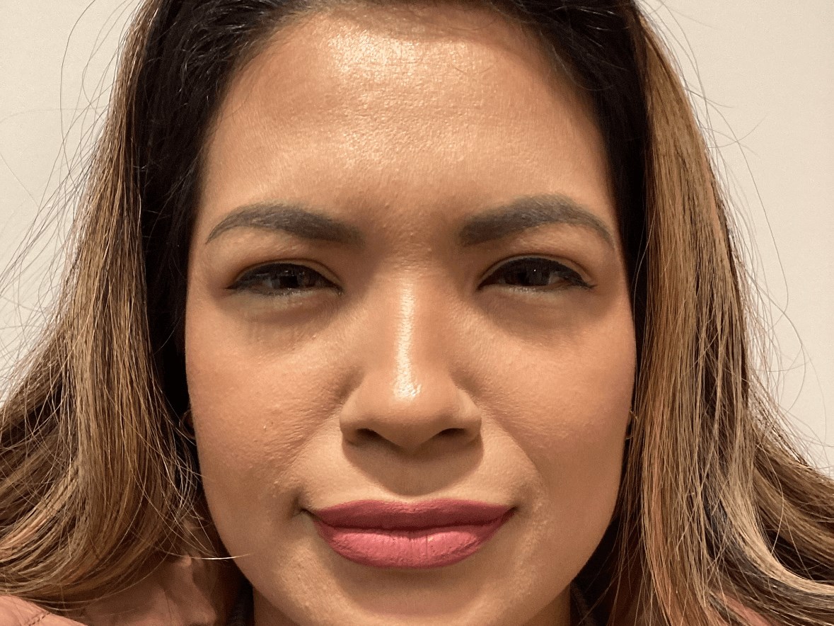 Glabella Botox After