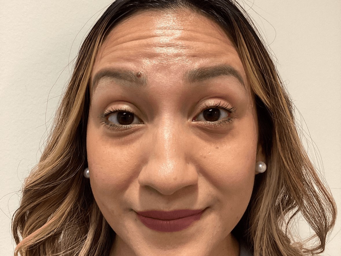 Forehead Botox Before