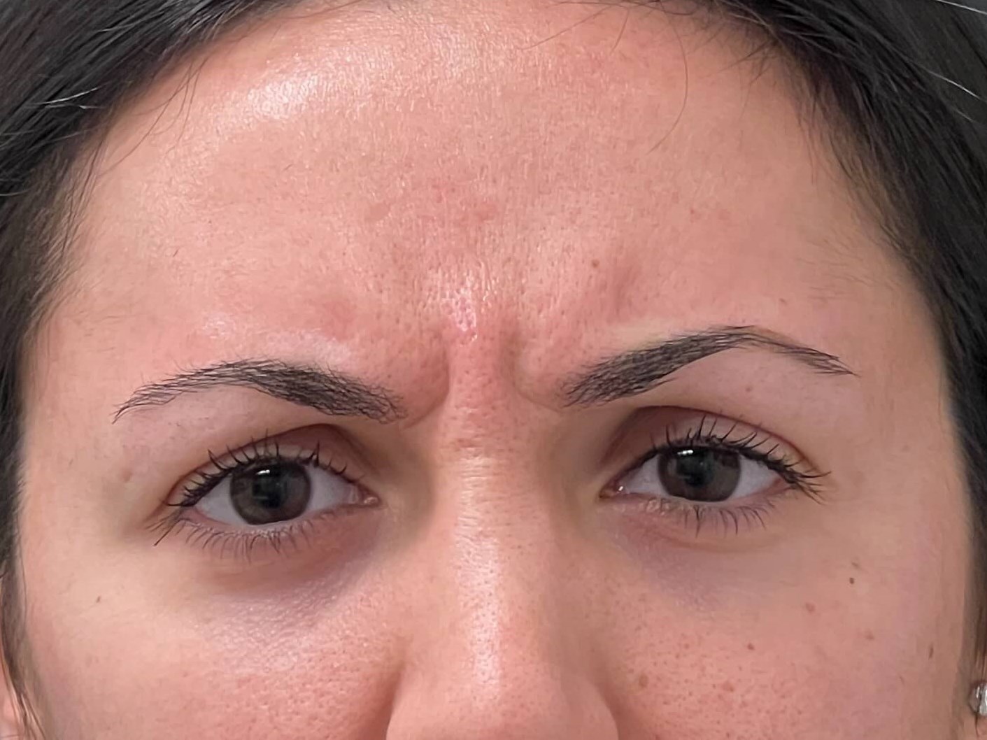 Flawless Forehead: Botox for S Before