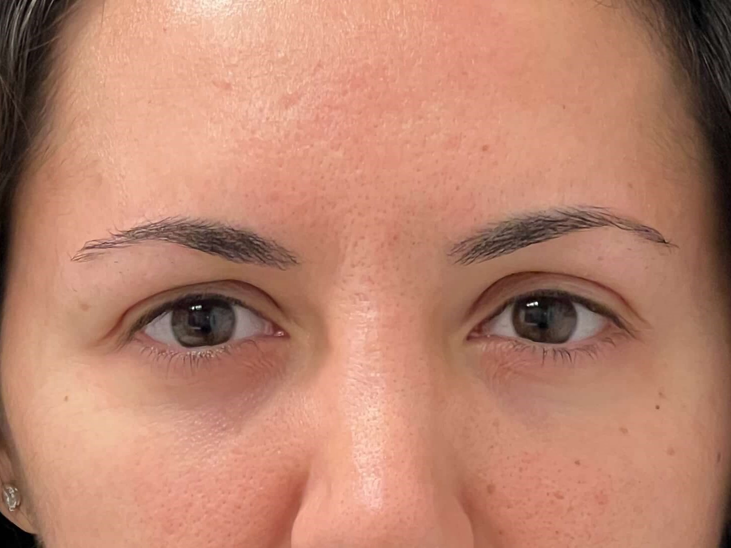 Flawless Forehead: Botox for S After