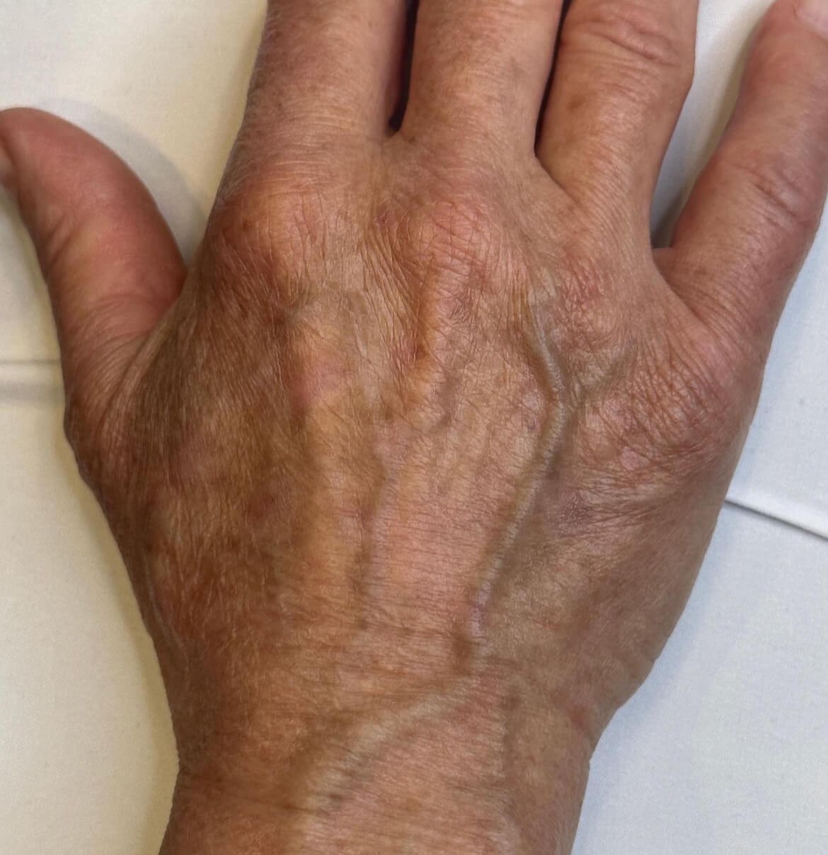 Hand Rejuvenation with BBL After