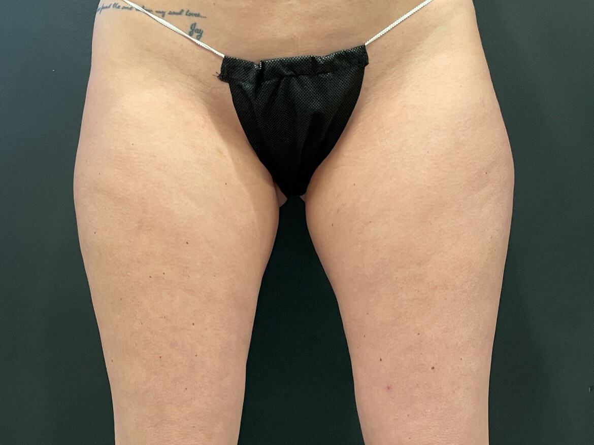 Coolsculpt Thighs Before