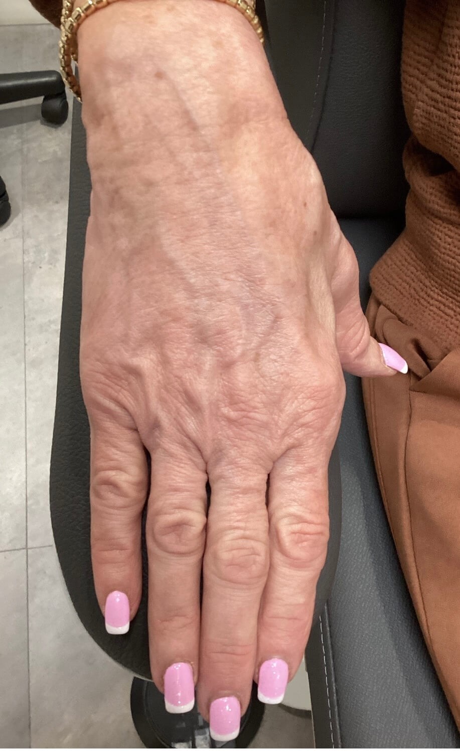 Instant Volume Restoration Before