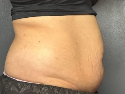 Non-Invasive Body Contouring Before
