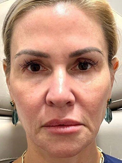 Ultimate Skin Rejuvenation Before