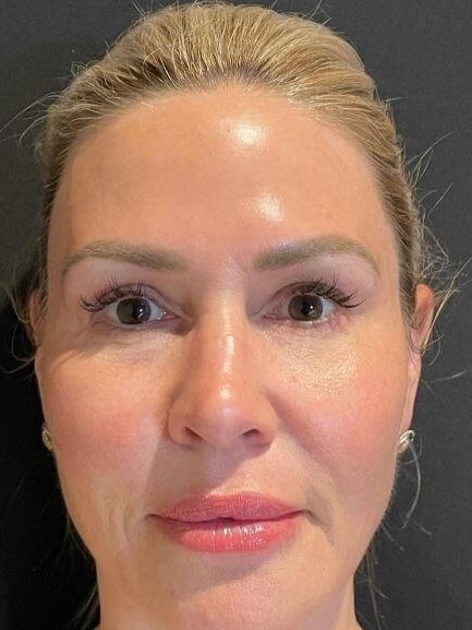 Ultimate Skin Rejuvenation After