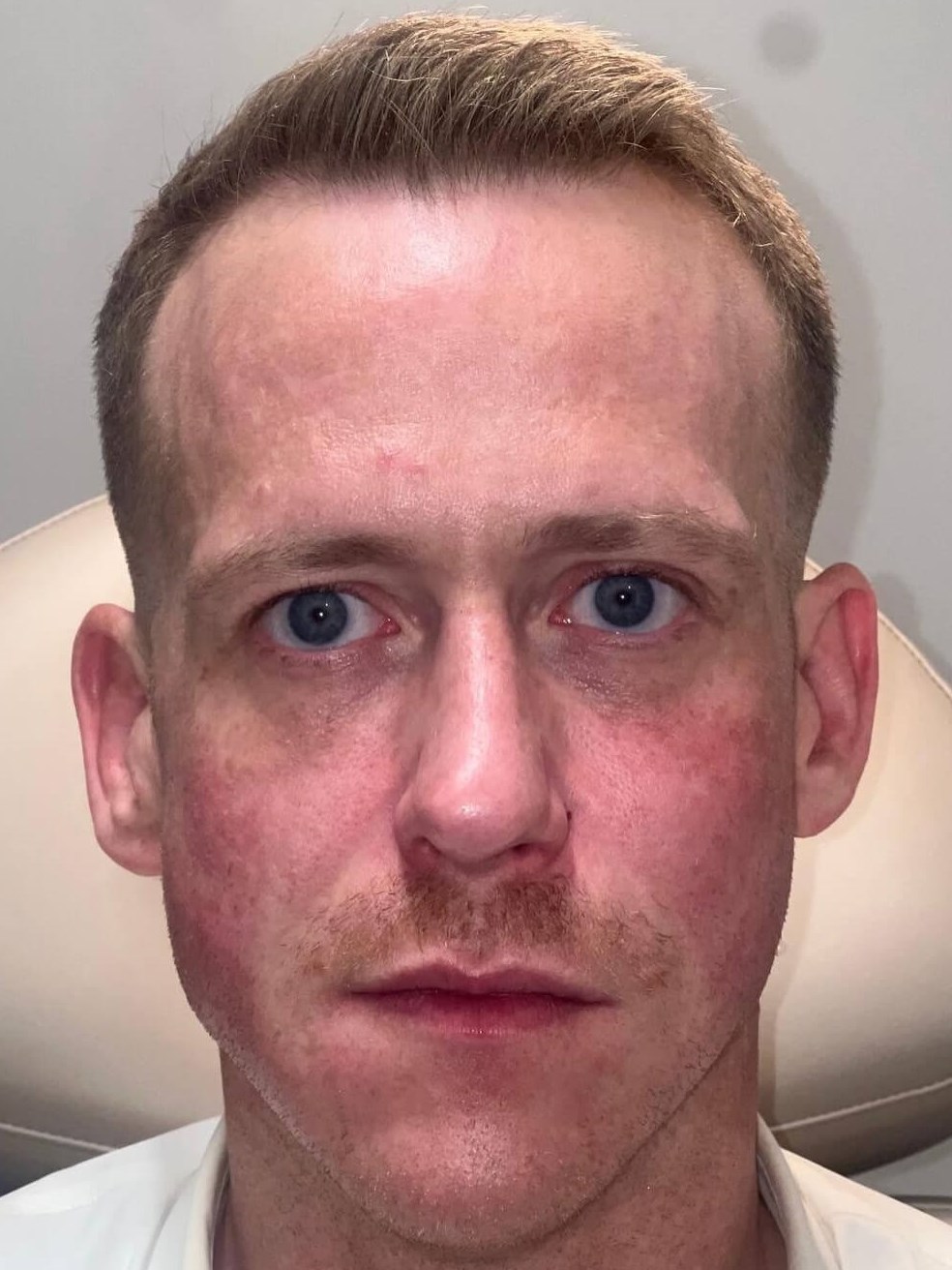 Sculptra for Men After
