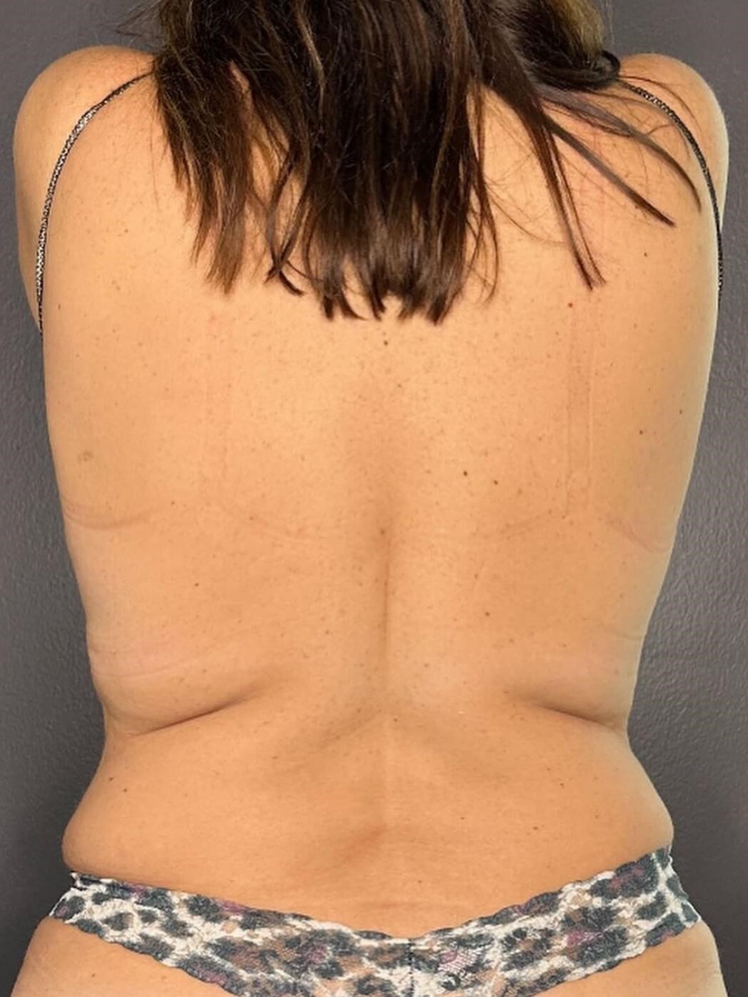 Freeze Away Stubborn Fat Before