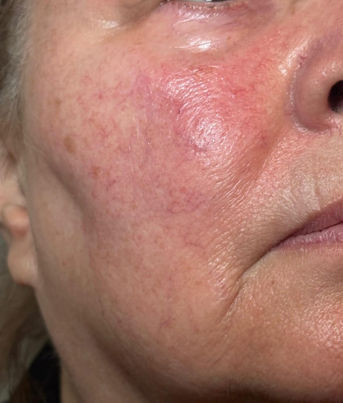 Clear & Even Skin with BBL Before