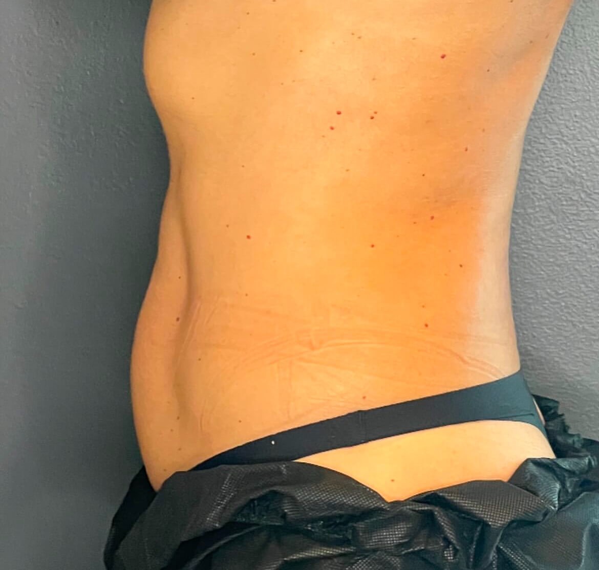 Transform Your Lower Abdomen Before
