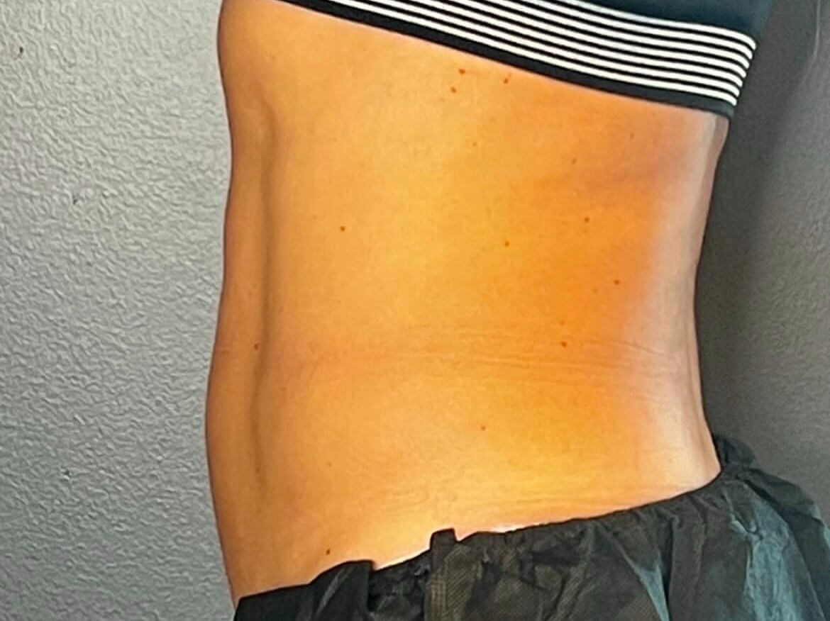 Transform Your Lower Abdomen After