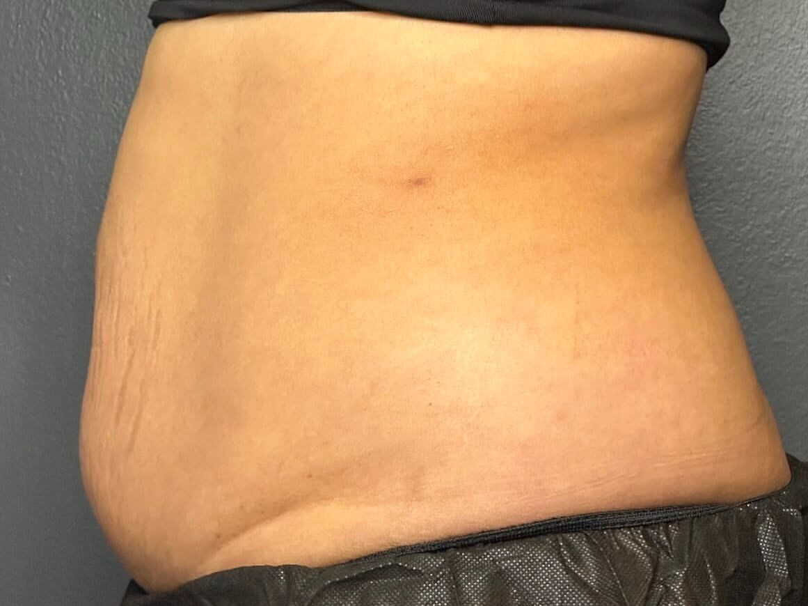 Coolsculpt your Flanks & Abs Before