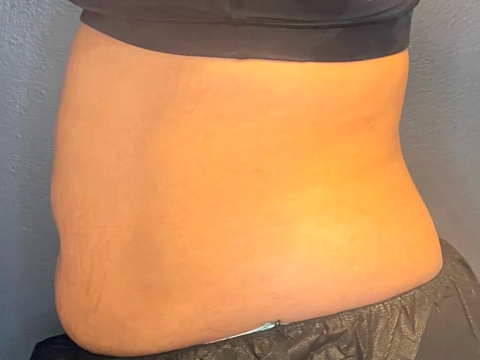 Coolsculpt your Flanks & Abs After