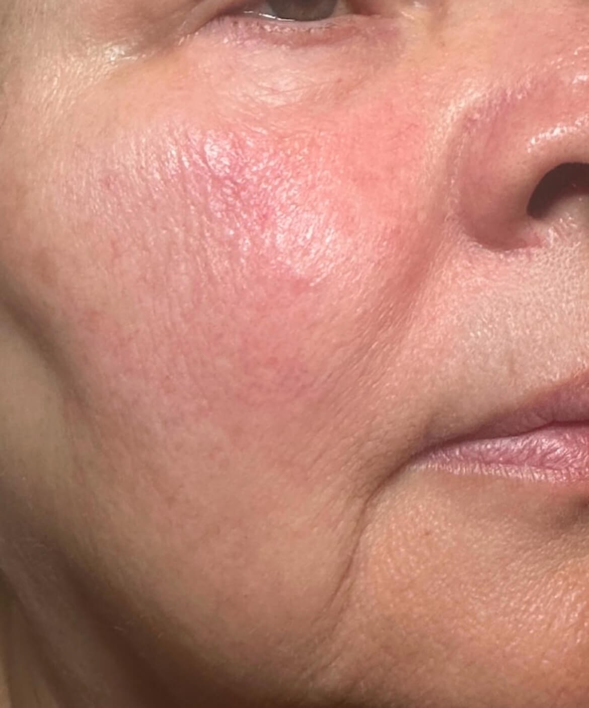 Clearer, Even Skin with BBLs After