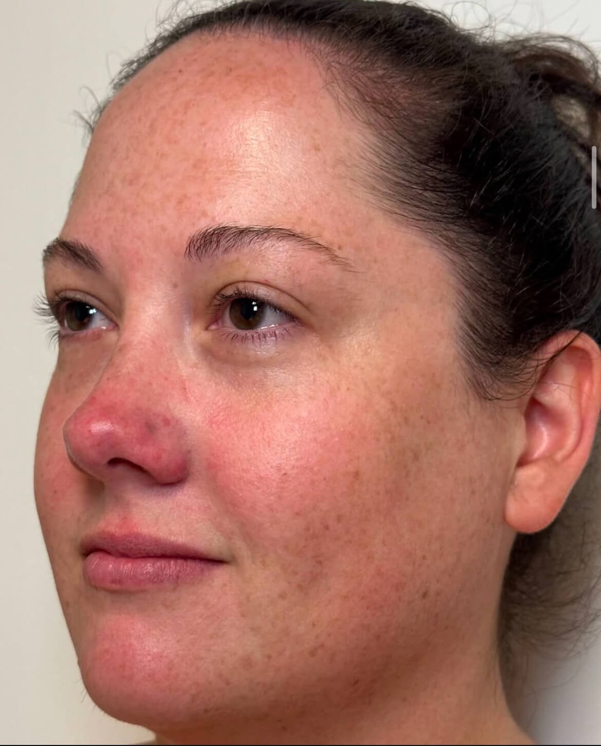 Complete Skin Rejuvenation Before
