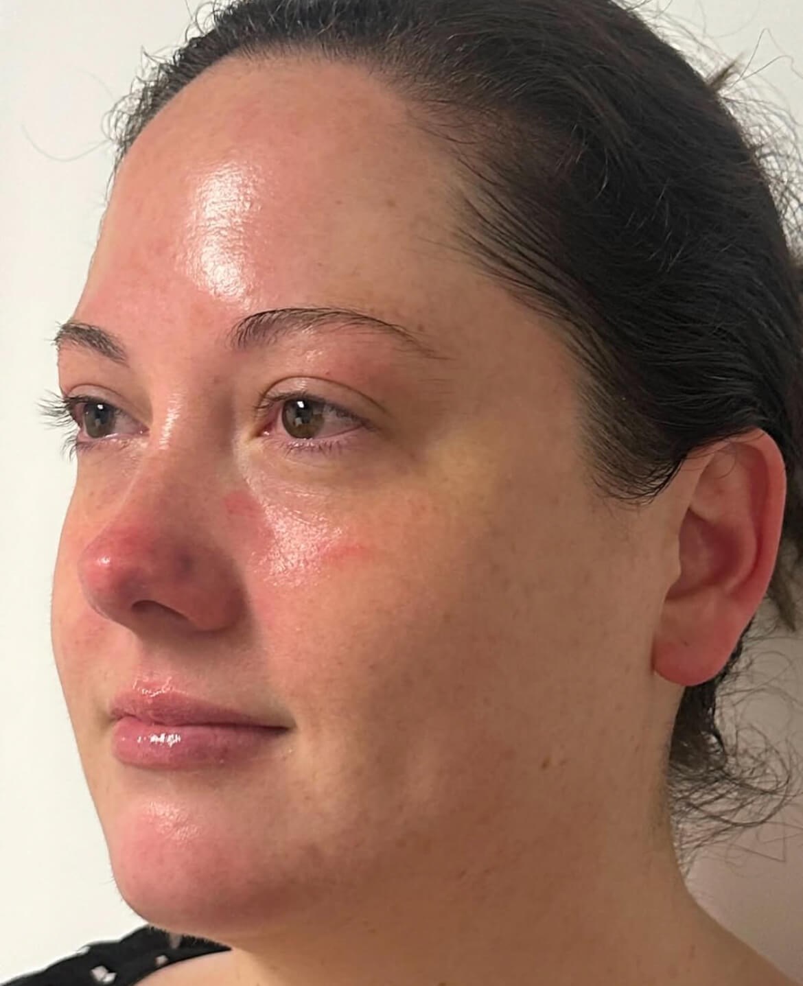 Complete Skin Rejuvenation After