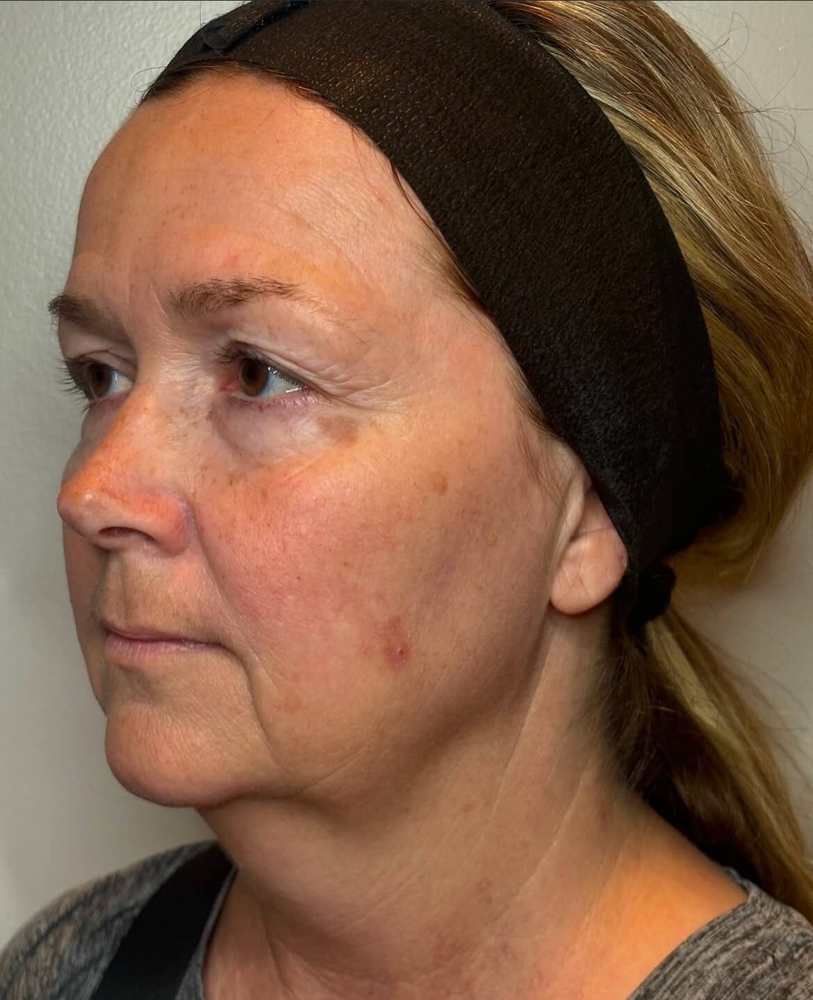 Revitalize Your Face and Neck Before