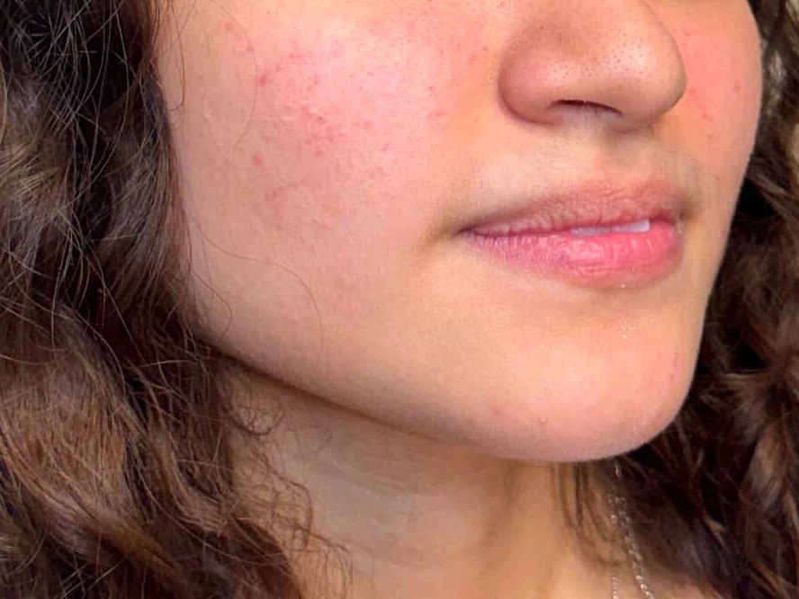 Enhance your Pout Before