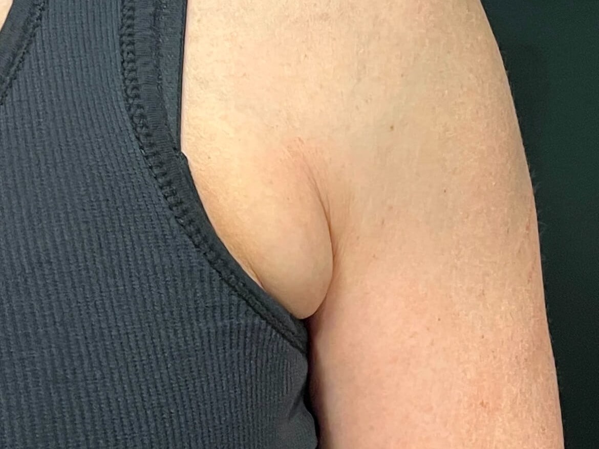 CoolSculpting for Bra Fat Before