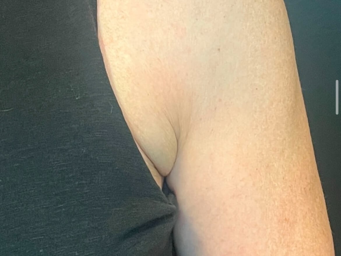CoolSculpting for Bra Fat After