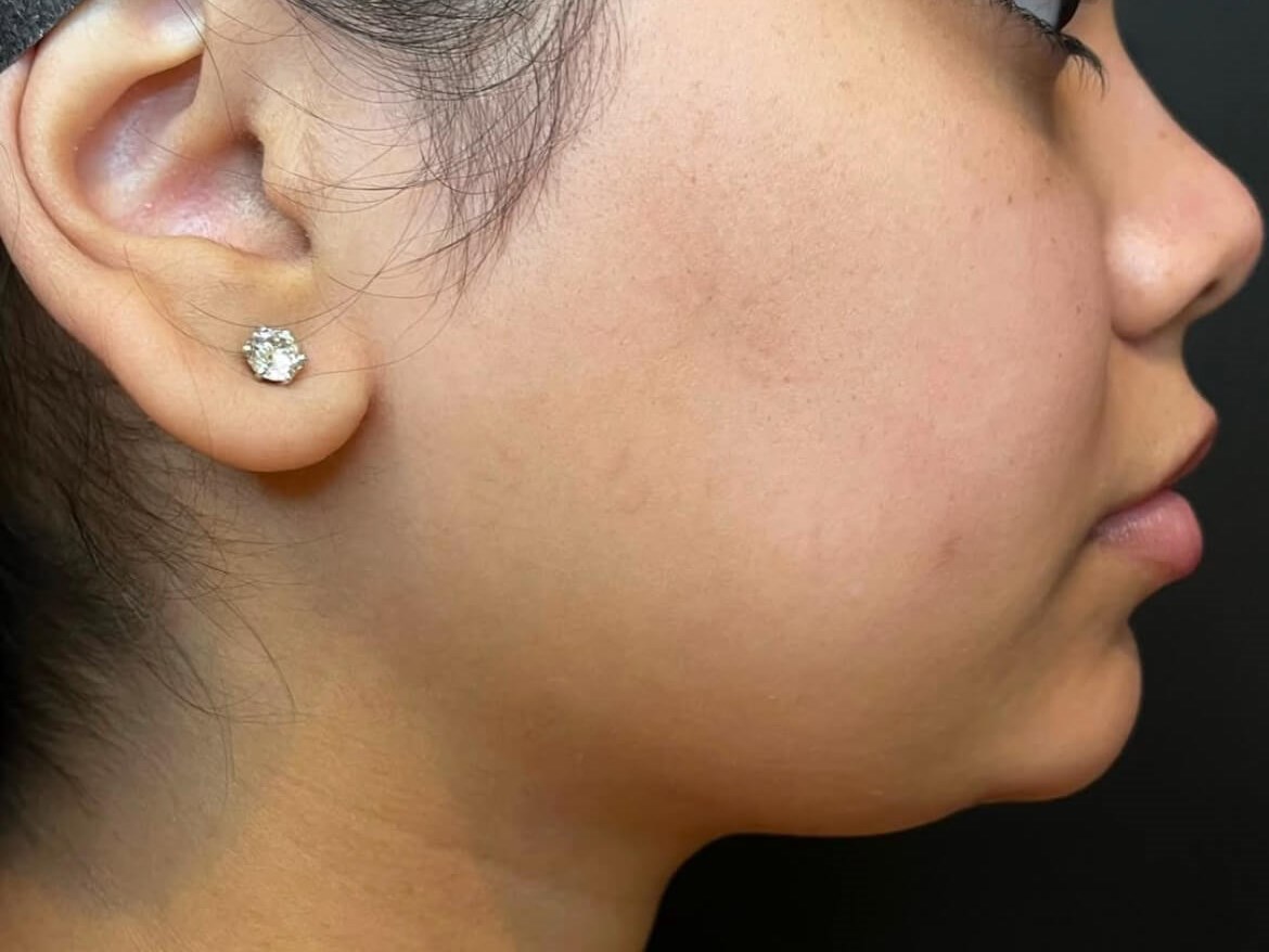 Lift & Define your Jawline Before