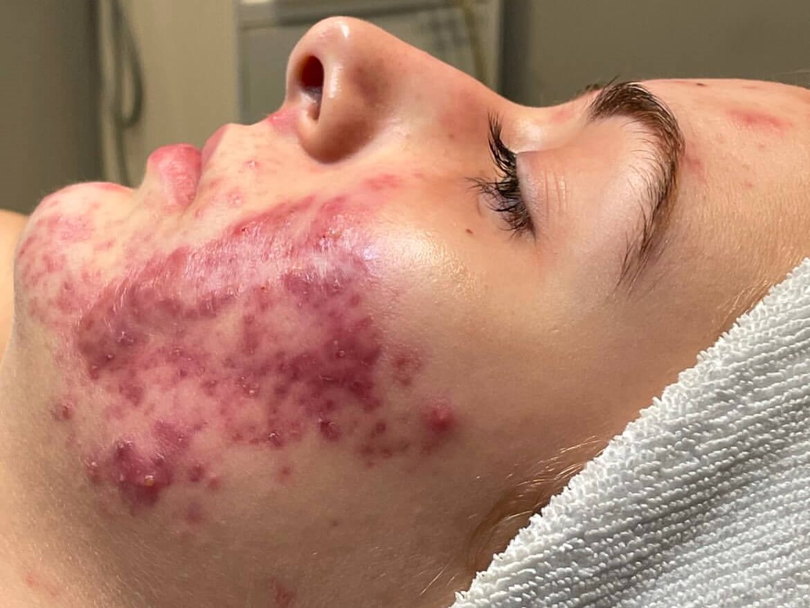 VI Peel at JEM Before